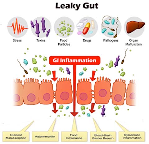 Chiropractic West Dundee IL Leaky Gut